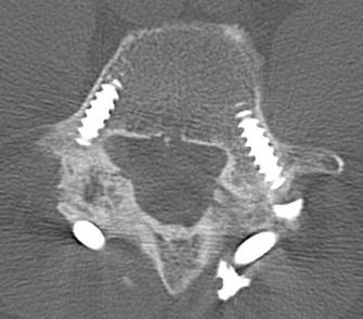 Bilateral Pars Defect Union